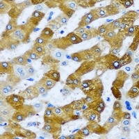 AARS2 Antibody - Immunohistochemical analysis of AARS2 staining in human liver cancer formalin fixed paraffin embedded tissue section. The section was pre-treated using heat mediated antigen retrieval with sodium citrate buffer (pH 6.0). The section was then incubated with the antibody at room temperature and detected using an HRP conjugated compact polymer system. DAB was used as the chromogen. The section was then counterstained with hematoxylin and mounted with DPX.
