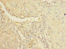 AARSD1 Antibody - Immunohistochemistry of paraffin-embedded human lung cancer using antibody at dilution of 1:100.