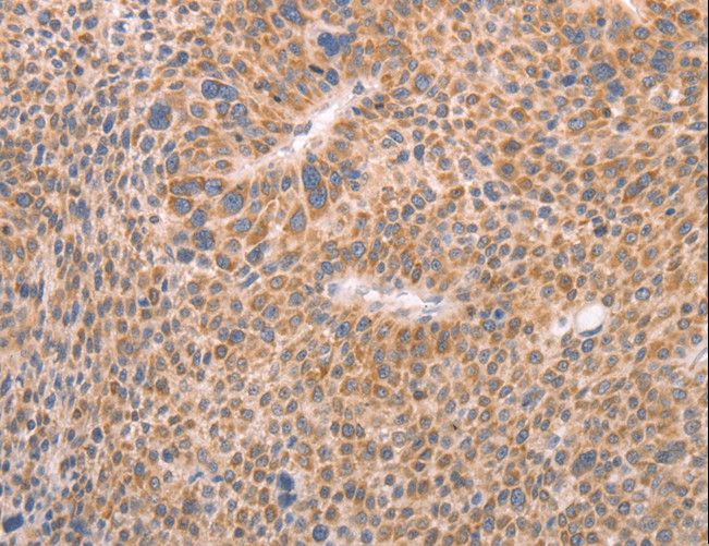 AASDHPPT / LYS5 Antibody - Immunohistochemistry of paraffin-embedded Human liver cancer using AASDHPPT Polyclonal Antibody at dilution of 1:30.