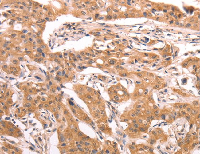 AASDHPPT / LYS5 Antibody - Immunohistochemistry of paraffin-embedded Human lung cancer using AASDHPPT Polyclonal Antibody at dilution of 1:30.
