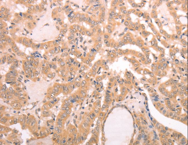 AASDHPPT / LYS5 Antibody - Immunohistochemistry of paraffin-embedded Human thyroid cancer using AASDHPPT Polyclonal Antibody at dilution of 1:30.
