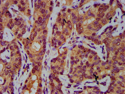 AASS / LKR / SDH Antibody - Immunohistochemistry Dilution at 1:400 and staining in paraffin-embedded human liver cancer performed on a Leica BondTM system. After dewaxing and hydration, antigen retrieval was mediated by high pressure in a citrate buffer (pH 6.0). Section was blocked with 10% normal Goat serum 30min at RT. Then primary antibody (1% BSA) was incubated at 4°C overnight. The primary is detected by a biotinylated Secondary antibody and visualized using an HRP conjugated SP system.