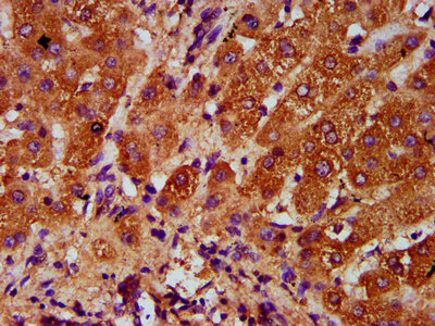 AASS / LKR / SDH Antibody - Immunohistochemistry Dilution at 1:400 and staining in paraffin-embedded human liver tissue performed on a Leica BondTM system. After dewaxing and hydration, antigen retrieval was mediated by high pressure in a citrate buffer (pH 6.0). Section was blocked with 10% normal Goat serum 30min at RT. Then primary antibody (1% BSA) was incubated at 4°C overnight. The primary is detected by a biotinylated Secondary antibody and visualized using an HRP conjugated SP system.