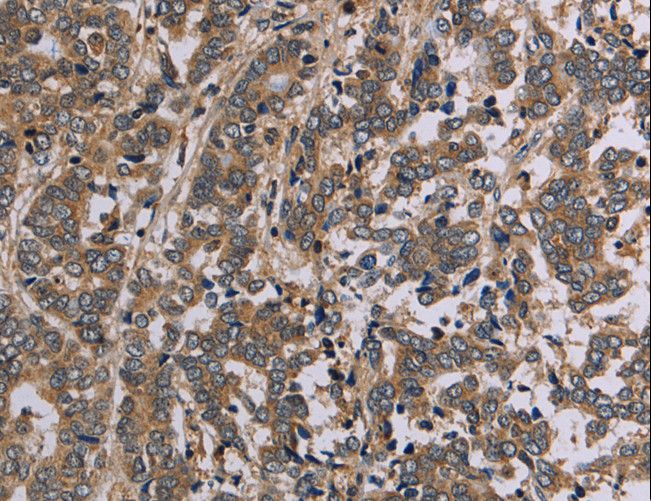 AATK / AATYK Antibody - Immunohistochemistry of paraffin-embedded Human liver cancer using AATK Polyclonal Antibody at dilution of 1:45.