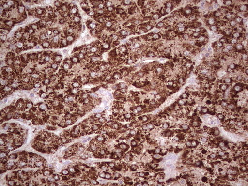 ABAT Antibody - Immunohistochemical staining of paraffin-embedded Carcinoma of Human liver tissue using anti-ABAT mouse monoclonal antibody. (Heat-induced epitope retrieval by 1 mM EDTA in 10mM Tris, pH8.5, 120C for 3min,