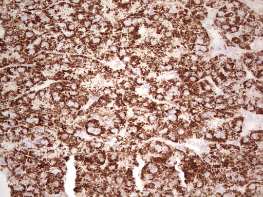 ABAT Antibody - Immunohistochemical staining of paraffin-embedded Carcinoma of Human liver tissue using anti-ABAT mouse monoclonal antibody. (Heat-induced epitope retrieval by 1 mM EDTA in 10mM Tris, pH8.5, 120C for 3min,