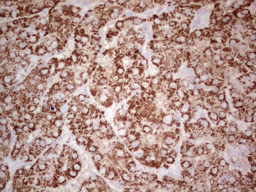 ABAT Antibody - IHC of paraffin-embedded Carcinoma of Human liver tissue using anti-ABAT mouse monoclonal antibody. (Heat-induced epitope retrieval by 1 mM EDTA in 10mM Tris, pH8.5, 120°C for 3min).