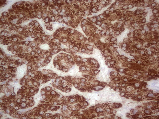 ABAT Antibody - IHC of paraffin-embedded Carcinoma of Human liver tissue using anti-ABAT mouse monoclonal antibody. (Heat-induced epitope retrieval by 1 mM EDTA in 10mM Tris, pH8.5, 120°C for 3min).