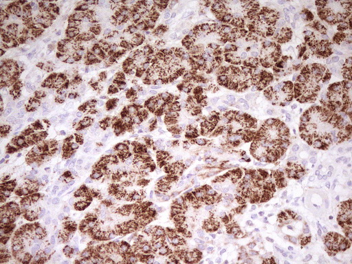 ABAT Antibody - Immunohistochemical staining of paraffin-embedded human pancreas tissue using ABAT clone UMAB178, mouse monoclonal antibody. (Heat-induced epitope retrieval by 1mM EDTA in 10mM Tris buffer. (pH8.0) at 120°C for 3 min,diluted 1:200 and detection shown with HRP enzyme and DAB chromogen. Images shows strong cytoplasmic and membranous staining is present in the exocrine gladular cells.