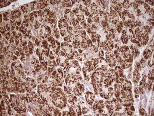 ABAT Antibody - Immunohistochemical staining of paraffin-embedded carcinoma of human pancreas tissue using ABAT clone UMAB178, mouse monoclonal antibody. Heat-induced epitope retrieval by 1mM EDTA in 10mM Tris buffer. (pH8.0) at 120C for 3 min,was diluted 1:200 and detection shown with HRP enzyme and DAB chromogen. Images shows strong cytoplasmic and membranous staining is present in the tumor cells.