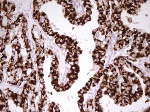 ABAT Antibody - Immunohistochemical staining of paraffin-embedded Carcinoma of Human thyroid tissue using anti-ABAT mouse monoclonal antibody. (Heat-induced epitope retrieval by 1mM EDTA in 10mM Tris buffer. (pH8.0) at 120C for 3 min. (1:200)