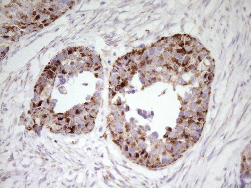 ABAT Antibody - Immunohistochemical staining of paraffin-embedded carcinoma of human kidney tissue using ABAT clone UMAB178, mouse monoclonal antibody. Heat-induced epitope retrieval by 1mM EDTA in 10mM Tris buffer. (pH8.0) at 120C for 3 min,was diluted 1:200 using HRP detection and DAB chromogen. Images shows strong cytoplasmic and membranous staining is present in the tumor cells.