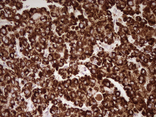 ABAT Antibody - Immunohistochemical staining of paraffin-embedded carcinoma of human liver tissue using ABAT clone UMAB178, mouse monoclonal antibody. Heat-induced epitope retrieval by 1mM EDTA in 10mM Tris buffer. (pH8.0) at 120C for 3 min,was diluted 1:200 using HRP detection and DAB chromogen. Images shows strong cytoplasmic and membranous staining is present in the tumor cells.