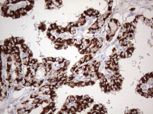 ABAT Antibody - Immunohistochemical staining of paraffin-embedded carcinoma of human thyroid tissue using ABAT clone UMAB179, mouse monoclonal antibody. Heat-induced epitope retrieval by 1mM EDTA in 10mM Tris buffer. (pH8.0 ) in pressure chamber/cooker at 110C for 3 min,was diluted 1:1000 using HRP detection and DAB chromogen. Image shows strong cytoplasmic and membranous staining is present in the tumor cells.