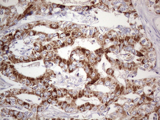 ABAT Antibody - Immunohistochemical staining of paraffin-embedded carcinoma of human liver tissue using anti-ABAT mouse monoclonal antibody. (Heat-induced epitope retrieval in pressure chamber/cooker at 110C for 3 min,. Images shows cancer cells with strong granular cytoplasmic staining.