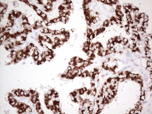 ABAT Antibody - Immunohistochemical staining of paraffin-embedded in human thyroid carcinoma using ABAT clone UMAB180 mouse monoclonal antibody. Heat-induced epitope retrieval with 1mM EDTA in 10mM Tris buffer. (pH8.0) at 110°C for 3 min prior todiluted 1:1000 application. Detection with HRP enzyme and DAB chromogen was use to visualize result. Image shows strong cytoplasmic and membranous staining is present in the tumor cells.