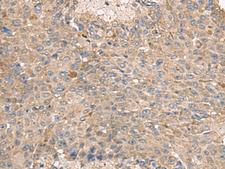 ABCA10 Antibody - Immunohistochemistry of paraffin-embedded Human liver cancer tissue  using ABCA10 Polyclonal Antibody at dilution of 1:50(×200)
