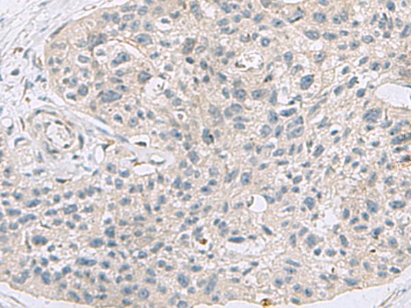 ABCA10 Antibody - Immunohistochemistry of paraffin-embedded Human esophagus cancer tissue  using ABCA10 Polyclonal Antibody at dilution of 1:50(×200)