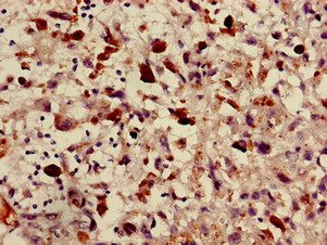 ABCA2 Antibody - Immunohistochemistry of paraffin-embedded human melanoma cancer using ABCA2 Antibody at dilution of 1:100