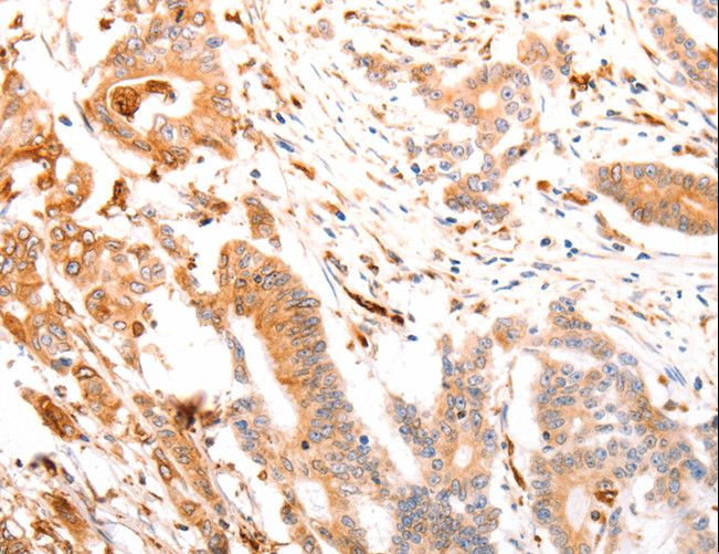 ABCA4 Antibody - Immunohistochemistry of paraffin-embedded Human thyroid cancer using ABCA4 Polyclonal Antibody at dilution of 1:30.