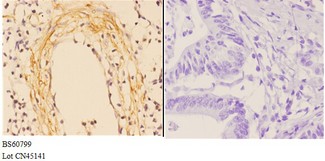 ABCA4 Antibody - Immunohistochemistry (IHC) analysis of ABCA4 antibody in paraffin-embedded human colon carcinoma tissue at 1:50, showing membrane staining. Negative control (the right) using PBS instead of primary antibody. Secondary antibody is Goat Anti-Rabbit IgG-biotin.