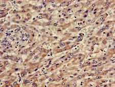 ABCA5 Antibody - Immunohistochemistry of paraffin-embedded human liver cancer using ABCA5 Antibody at dilution of 1:100