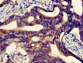ABCA5 Antibody - Immunohistochemistry of paraffin-embedded human colon cancer using ABCA5 Antibody at dilution of 1:100