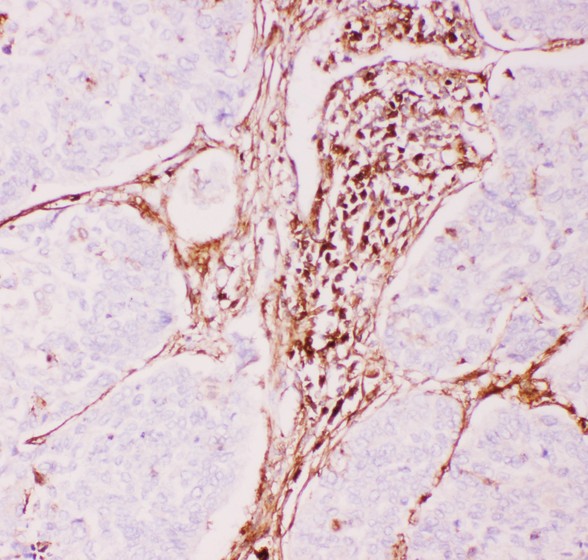 ABCB1 / MDR1 / P Glycoprotein Antibody - P Glycoprotein antibody IHC-paraffin: Human Lung Cancer Tissue.