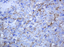 ABCB1 / MDR1 / P Glycoprotein Antibody - IHC of paraffin-embedded Adenocarcinoma of Human colon tissue using anti-ABCB1 mouse monoclonal antibody.