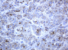 ABCB1 / MDR1 / P Glycoprotein Antibody - IHC of paraffin-embedded Carcinoma of Human liver tissue using anti-ABCB1 mouse monoclonal antibody.
