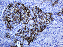 ABCB1 / MDR1 / P Glycoprotein Antibody - IHC of paraffin-embedded Human lymphoma tissue using anti-ABCB1 mouse monoclonal antibody.