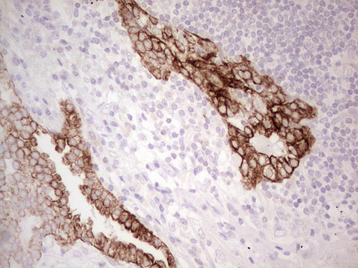 ABCB1 / MDR1 / P Glycoprotein Antibody - Immunohistochemical staining of paraffin-embedded Carcinoma of Human lung tissue using anti-ABCB1 mouse monoclonal antibody. (Heat-induced epitope retrieval by 1 mM EDTA in 10mM Tris, pH8.5, 120C for 3min,