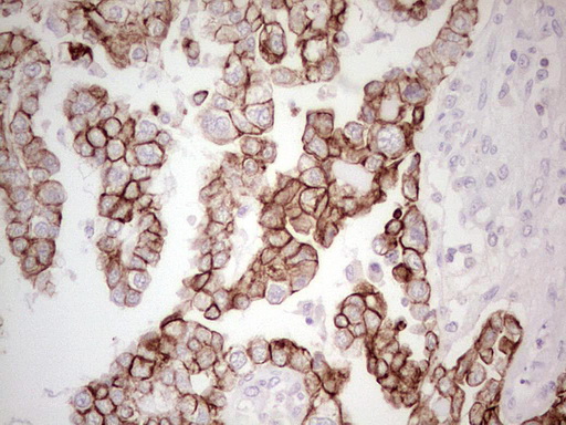 ABCB1 / MDR1 / P Glycoprotein Antibody - Immunohistochemical staining of paraffin-embedded Adenocarcinoma of Human ovary tissue using anti-ABCB1 mouse monoclonal antibody. (Heat-induced epitope retrieval by 1 mM EDTA in 10mM Tris, pH8.5, 120C for 3min,
