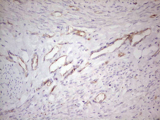 ABCB1 / MDR1 / P Glycoprotein Antibody - Immunohistochemical staining of paraffin-embedded Adenocarcinoma of Human endometrium tissue using anti-ABCB1 mouse monoclonal antibody. (Heat-induced epitope retrieval by 1 mM EDTA in 10mM Tris, pH8.5, 120C for 3min,