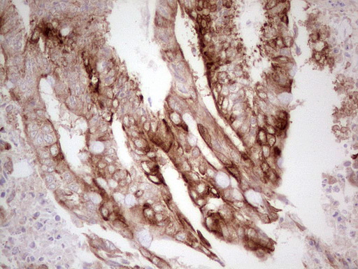ABCB1 / MDR1 / P Glycoprotein Antibody - IHC of paraffin-embedded Adenocarcinoma of Human colon tissue using anti-ABCB1 mouse monoclonal antibody. (Heat-induced epitope retrieval by 1 mM EDTA in 10mM Tris, pH8.5, 120°C for 3min).