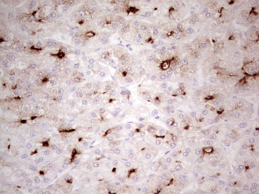 ABCB1 / MDR1 / P Glycoprotein Antibody - IHC of paraffin-embedded Carcinoma of Human liver tissue using anti-ABCB1 mouse monoclonal antibody. (Heat-induced epitope retrieval by 1 mM EDTA in 10mM Tris, pH8.5, 120°C for 3min).