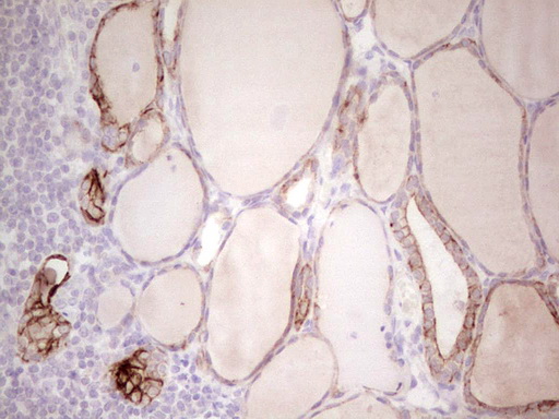 ABCB1 / MDR1 / P Glycoprotein Antibody - IHC of paraffin-embedded Human thyroid tissue using anti-ABCB1 mouse monoclonal antibody. (Heat-induced epitope retrieval by 1 mM EDTA in 10mM Tris, pH8.5, 120°C for 3min).
