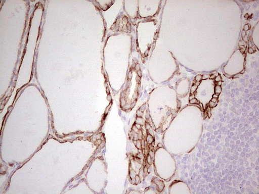 ABCB1 / MDR1 / P Glycoprotein Antibody - Immunohistochemical staining of paraffin-embedded Human thyroid tissue within the normal limits using anti-ABCB1 mouse monoclonal antibody. (Heat-induced epitope retrieval by 1 mM EDTA in 10mM Tris, pH8.5, 120C for 3min,