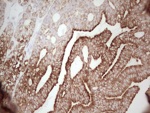 ABCB1 / MDR1 / P Glycoprotein Antibody - Immunohistochemical staining of paraffin-embedded Carcinoma of Human thyroid tissue using anti-ABCB1 mouse monoclonal antibody. (Heat-induced epitope retrieval by 1 mM EDTA in 10mM Tris, pH8.5, 120C for 3min,