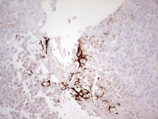 ABCB1 / MDR1 / P Glycoprotein Antibody - Immunohistochemical staining of paraffin-embedded Human tonsil within the normal limits using anti-ABCB1 mouse monoclonal antibody. (Heat-induced epitope retrieval by 1 mM EDTA in 10mM Tris, pH8.5, 120C for 3min,
