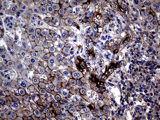 ABCB1 / MDR1 / P Glycoprotein Antibody - Immunohistochemical staining of paraffin-embedded Carcinoma of Human liver tissue using anti-ABCB1 mouse monoclonal antibody. (Heat-induced epitope retrieval by 1mM EDTA in 10mM Tris buffer. (pH8.5) at 120°C for 3 min. (1:2000)