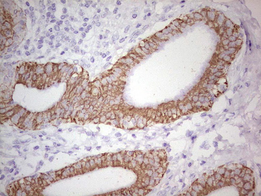 ABCB1 / MDR1 / P Glycoprotein Antibody - Immunohistochemical staining of paraffin-embedded Carcinoma of Human pancreas tissue using anti-ABCB1 mouse monoclonal antibody. (Heat-induced epitope retrieval by 1 mM EDTA in 10mM Tris, pH8.5, 120C for 3min,