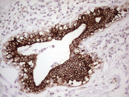 ABCB1 / MDR1 / P Glycoprotein Antibody - Immunohistochemical staining of paraffin-embedded Adenocarcinoma of Human breast tissue using anti-ABCB1 mouse monoclonal antibody. (Heat-induced epitope retrieval by 1 mM EDTA in 10mM Tris, pH8.5, 120C for 3min,