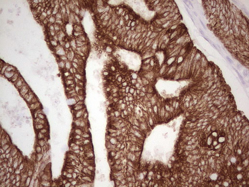 ABCB1 / MDR1 / P Glycoprotein Antibody - Immunohistochemical staining of paraffin-embedded Adenocarcinoma of Human colon tissue using anti-ABCB1 mouse monoclonal antibody. (Heat-induced epitope retrieval by 1 mM EDTA in 10mM Tris, pH8.5, 120C for 3min,