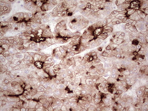 ABCB1 / MDR1 / P Glycoprotein Antibody - Immunohistochemical staining of paraffin-embedded Carcinoma of Human liver tissue using anti-ABCB1 mouse monoclonal antibody. (Heat-induced epitope retrieval by 1 mM EDTA in 10mM Tris, pH8.5, 120C for 3min,