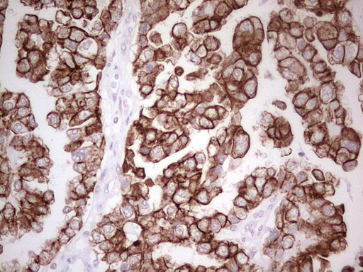 ABCB1 / MDR1 / P Glycoprotein Antibody - IHC of paraffin-embedded Adenocarcinoma of Human ovary tissue using anti-ABCB1 mouse monoclonal antibody. (Heat-induced epitope retrieval by 1 mM EDTA in 10mM Tris, pH8.5, 120°C for 3min).