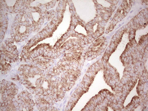 ABCB1 / MDR1 / P Glycoprotein Antibody - IHC of paraffin-embedded Carcinoma of Human thyroid tissue using anti-ABCB1 mouse monoclonal antibody. (Heat-induced epitope retrieval by 1 mM EDTA in 10mM Tris, pH8.5, 120°C for 3min).