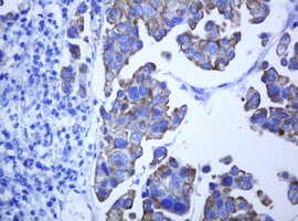 ABCB1 / MDR1 / P Glycoprotein Antibody - IHC of paraffin-embedded Carcinoma of Human bladder tissue using anti-ABCB1 mouse monoclonal antibody.
