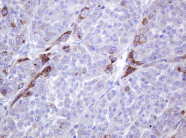 ABCB1 / MDR1 / P Glycoprotein Antibody - IHC of paraffin-embedded Carcinoma of Human liver tissue using anti-ABCB1 mouse monoclonal antibody. (Heat-induced epitope retrieval by 10mM citric buffer, pH6.0, 120°C for 3min).