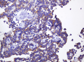ABCB1 / MDR1 / P Glycoprotein Antibody - IHC of paraffin-embedded Carcinoma of Human pancreas tissue using anti-ABCB1 mouse monoclonal antibody. (Heat-induced epitope retrieval by 10mM citric buffer, pH6.0, 120°C for 3min).